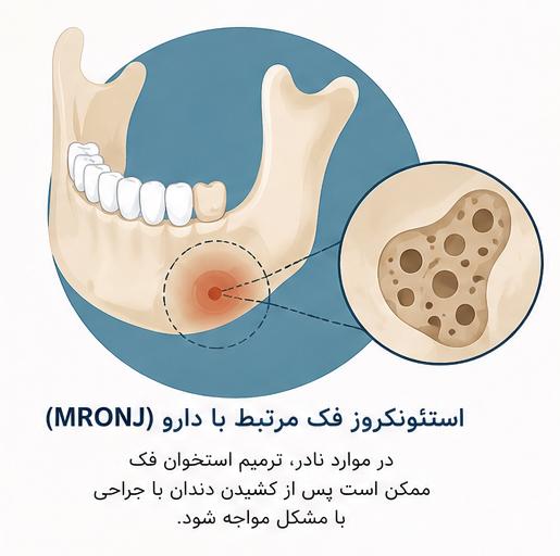 استئونکروز فک